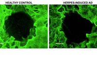 Forskarna har bland annat sett hur den odlade minihjärnan förlorar nervceller när den infekteras av munsårsvirus. Den vänstra bilden visar frisk hjärnvävnad, den högra infekterad.