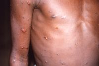 Apkoppor ger upphov till utslag, sår och blåsor. Symtomen är ofta milda men kan bli allvarliga hos personer i riskgrupper. Arkivbild från Kongo-Kinshasa.