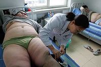 En läkare i Kina ger sin patient akupunktur som hjälp för att gå ner i vikt.