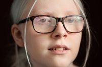 Albinism är en sjukdom, men Allis upplever inte att det är en sjukdom som hon är sjuk av. I dag lever ungefär 500 personer i Sverige med albinism.