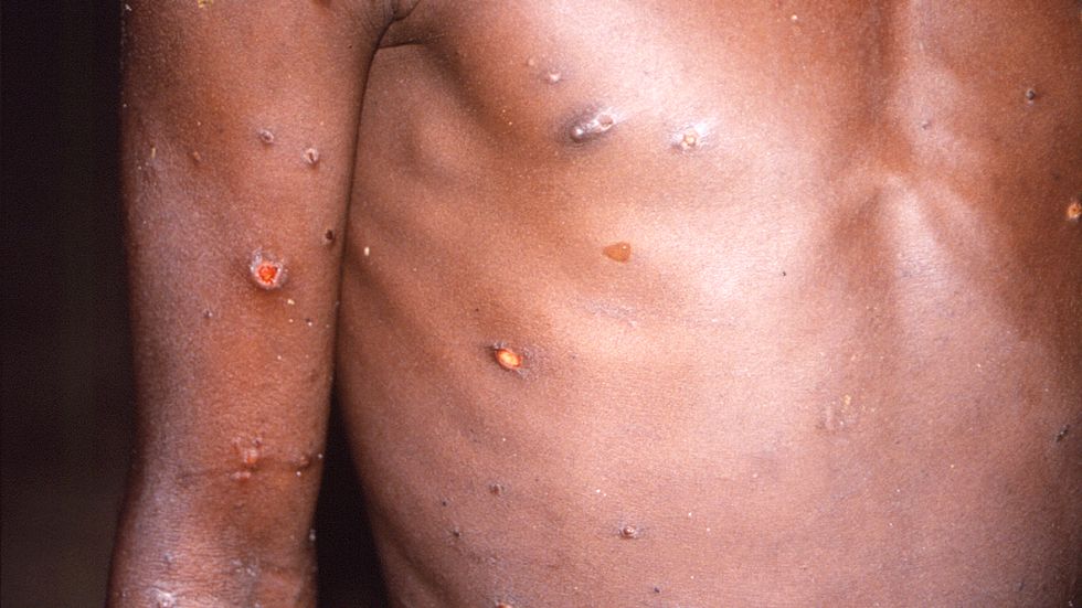 En bild på apkoppor från 1997 som distribuerats av CDC, USA:s motsvarighet till Folkhälsomyndigheten.