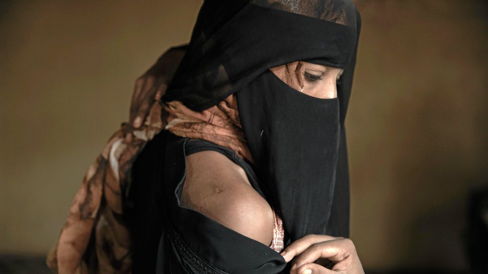 En etiopisk kvinna visar ärr efter tortyren i Ras al-Ara.