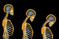 Daotorframställd bild av benskörhetens effekt på skelettet hos en kvinna. Benets densitet minskar, ryggraden trycks ihop och böjs med tiden framåt. ”Kvinnor som passerat klimakteriet drabbas värst”, säger Sol-Britt Sundvall, vice ordförande i Osteoporosförbundet.