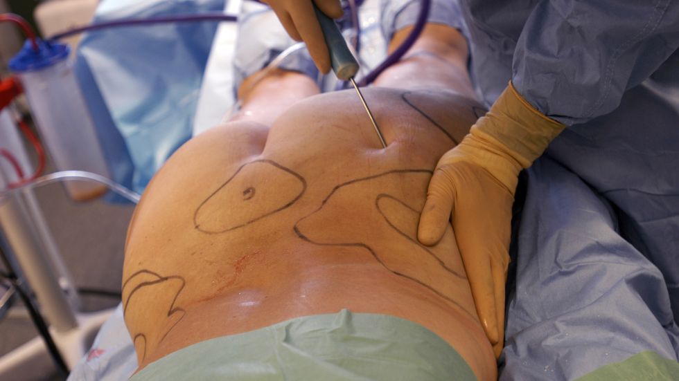 Plastikkirurgen Ulf Samuelson möter regelbundet patienter som har problem efter både estetiska injektioner och plastikkirurgi. På bilden en fettsugning av mage och lår på Akademikliniken på Östermalm.