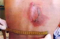 Polisens foto av en av Lundsbergselevernas brännmärkta rygg. Två elever brändes med strykjärn under en ”nollning” i augusti.