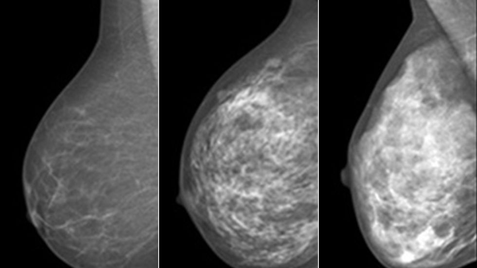 Mammografibilder på tre olika bröst med olika täthet på körtelvävnaden. Så kallade täta bröst gör det svårare att upptäcka en tumör vid vanlig screening. 