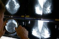 Traditionella blodfettssänkande mediciner kan troligen användas för att behandla bröstcancer. Det bedömer forskare på Skånes universitetssjukhus i Lund, som har utfört en klinisk studie på 50 kvinnor med bröstcancer.