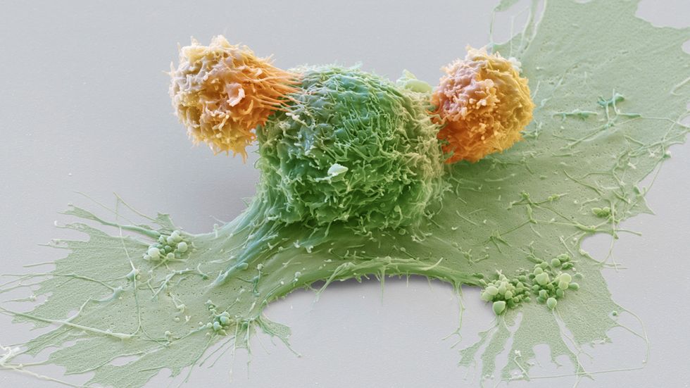 Bröstcancercell (grön) attackeras av T-celler. Färgad bild tagen med svepelektronmikroskop. 